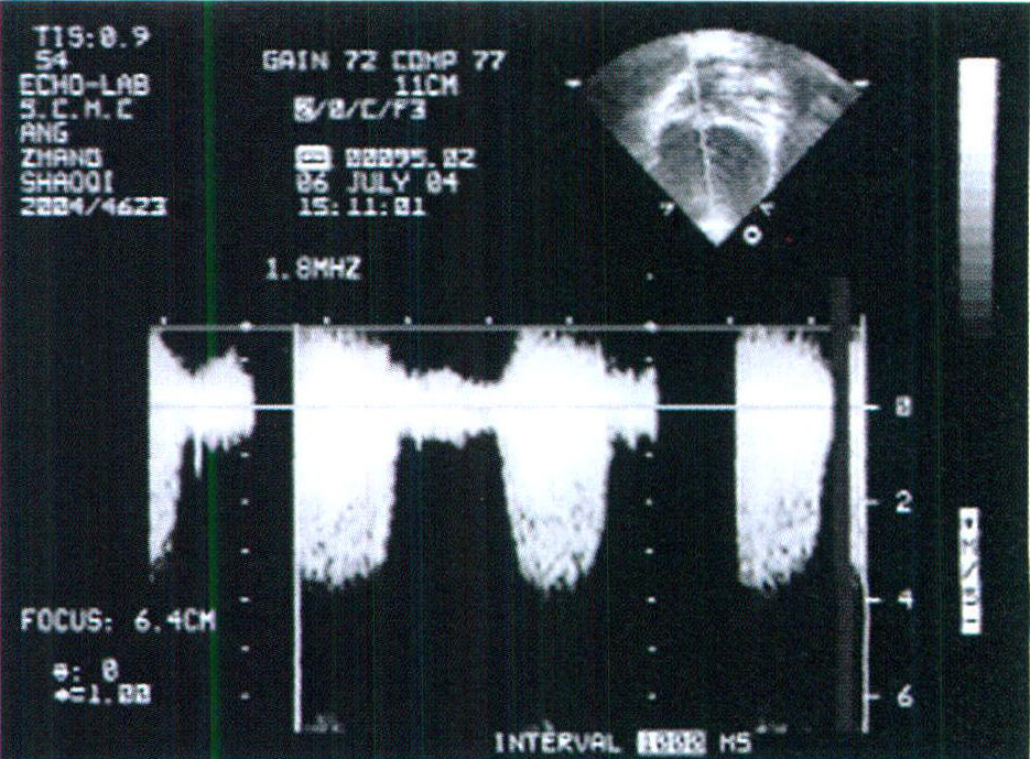 图例8 完全性大动脉转位伴室间隔缺损及肺动脉狭窄(一)
